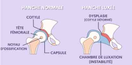 Dysplasie de la hanche